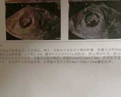 天津试管婴儿和代孕的别,做试管婴儿会导致乳腺癌的发生？_卵巢过度刺激移植